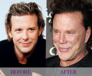 Celecrities bad surgery